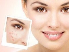 脸上长痘的搞笑说说 脸上长痘的经典签名