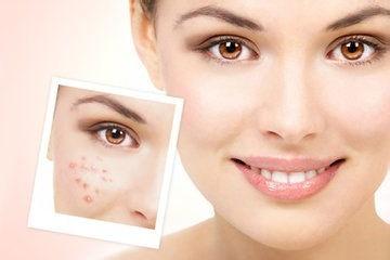 脸上长痘的搞笑说说